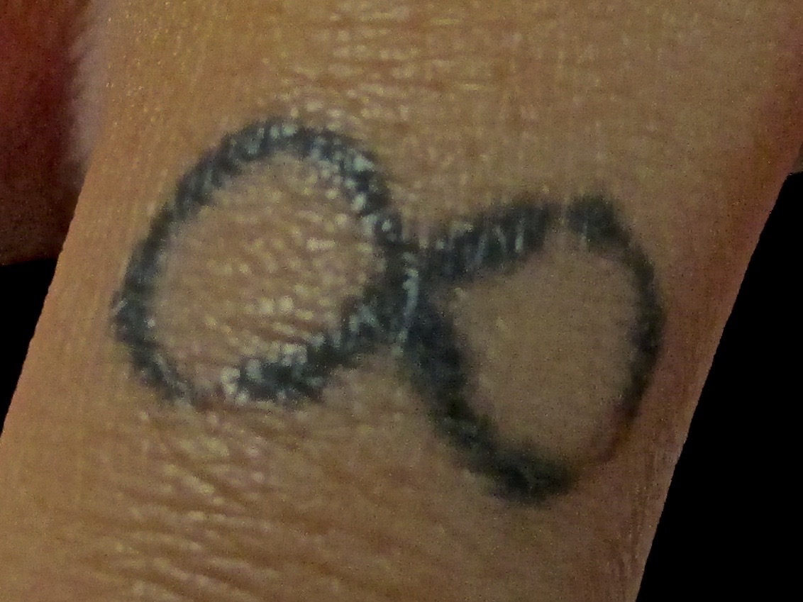 infinity tattoo before removal